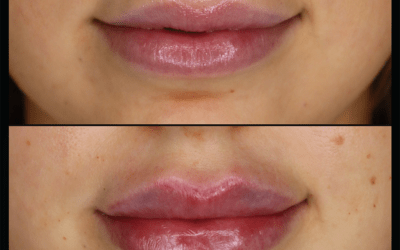 before and after results from filler treatment at 5th and Wellness in Boca Raton, FL