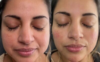 before and after results from filler treatment at 5th and Wellness in Boca Raton, FL