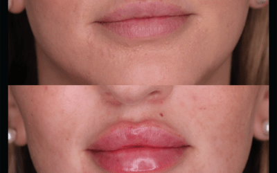 before and after results from filler treatment at 5th and Wellness in Boca Raton, FL