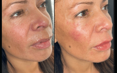 before and after results from filler treatment at 5th and Wellness in Boca Raton, FL