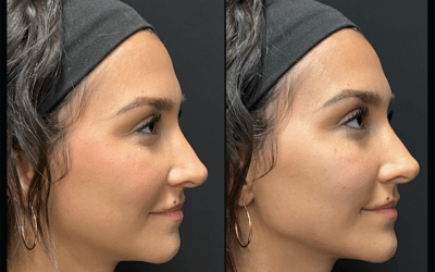 before and after results from filler treatment at 5th and Wellness in Boca Raton, FL