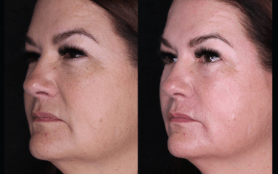 before and after results from filler treatment at 5th and Wellness in Boca Raton, FL