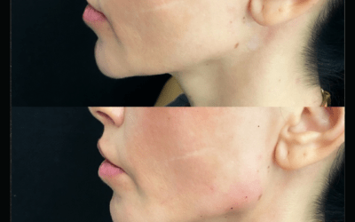 before and after results from filler treatment at 5th and Wellness in Boca Raton, FL