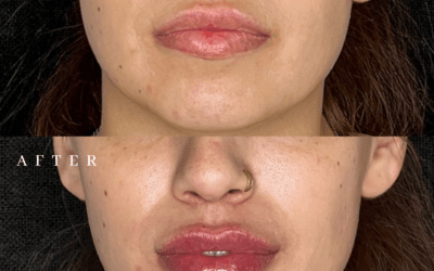 before and after results from filler treatment at 5th and Wellness in Boca Raton, FL