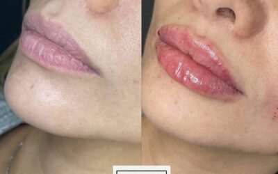 before and after results from filler treatment at 5th and Wellness in Boca Raton, FL