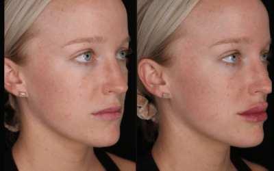 before and after results from filler treatment at 5th and Wellness in Boca Raton, FL