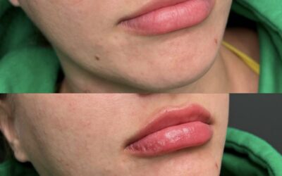 before and after results from filler treatment at 5th and Wellness in Boca Raton, FL