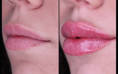 before and after results from filler treatment at 5th and Wellness in Boca Raton, FL