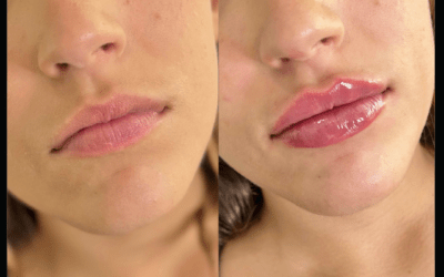 before and after results from filler treatment at 5th and Wellness in Boca Raton, FL