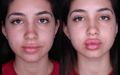 before and after results from filler treatment at 5th and Wellness in Boca Raton, FL