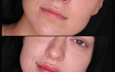 before and after results from filler treatment at 5th and Wellness in Boca Raton, FL