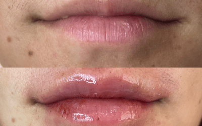 before and after results from filler treatment at 5th and Wellness in Boca Raton, FL