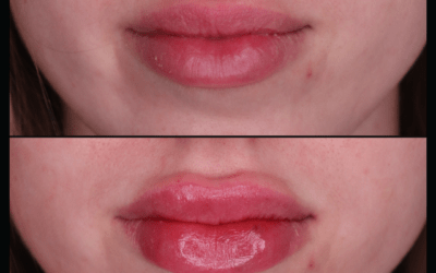 before and after results from filler treatment at 5th and Wellness in Boca Raton, FL