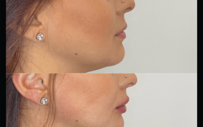 before and after results from filler treatment at 5th and Wellness in Boca Raton, FL