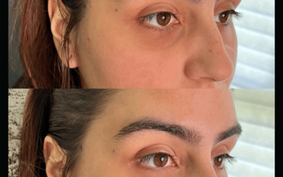 before and after results from filler treatment at 5th and Wellness in Boca Raton, FL