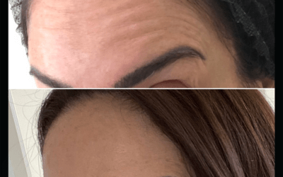 before and after results from filler treatment at 5th and Wellness in Boca Raton, FL