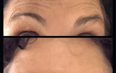 before and after results from filler treatment at 5th and Wellness in Boca Raton, FL