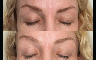 before and after results from filler treatment at 5th and Wellness in Boca Raton, FL