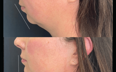 before and after results from filler treatment at 5th and Wellness in Boca Raton, FL