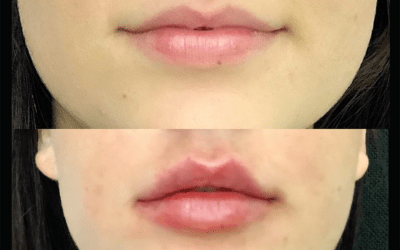 before and after results from filler treatment at 5th and Wellness in Boca Raton, FL