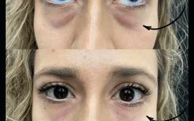 before and after results from filler treatment at 5th and Wellness in Boca Raton, FL