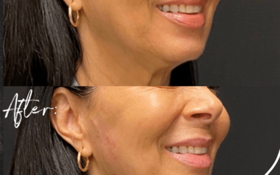 before and after results from filler treatment at 5th and Wellness in Boca Raton, FL