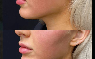 before and after results from filler treatment at 5th and Wellness in Boca Raton, FL