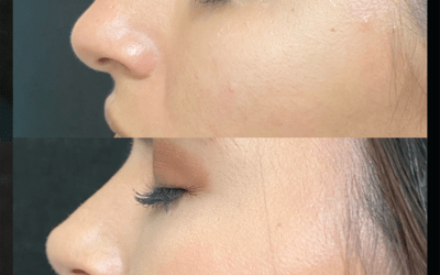 before and after results from filler treatment at 5th and Wellness in Boca Raton, FL