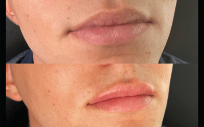 before and after results from filler treatment at 5th and Wellness in Boca Raton, FL