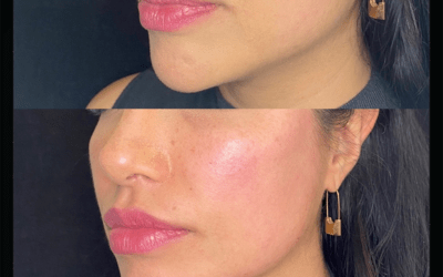 before and after results from filler treatment at 5th and Wellness in Boca Raton, FL