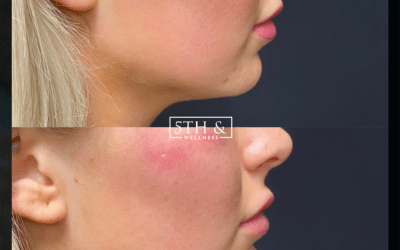 before and after results from filler treatment at 5th and Wellness in Boca Raton, FL