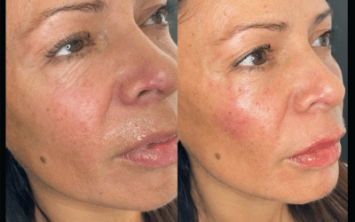 before and after results from filler treatment at 5th and Wellness in Boca Raton, FL