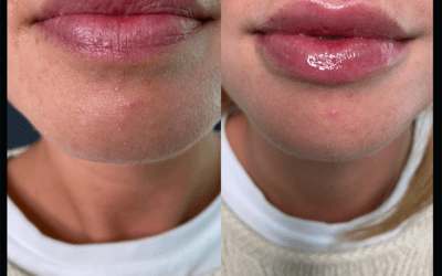 before and after results from filler treatment at 5th and Wellness in Boca Raton, FL