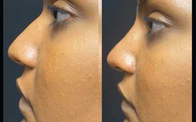 before and after results from filler treatment at 5th and Wellness in Boca Raton, FL