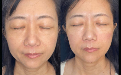 before and after results from filler treatment at 5th and Wellness in Boca Raton, FL