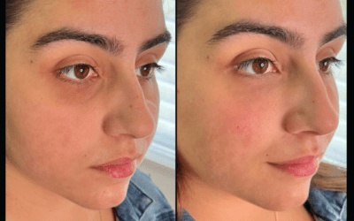 before and after results from filler treatment at 5th and Wellness in Boca Raton, FL