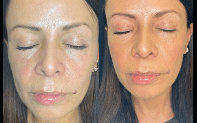 before and after results from filler treatment at 5th and Wellness in Boca Raton, FL