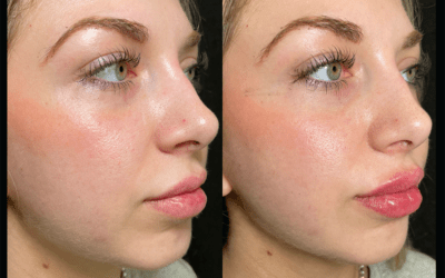 before and after results from filler treatment at 5th and Wellness in Boca Raton, FL