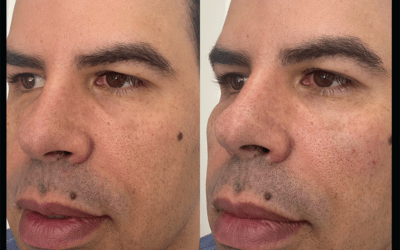 before and after results from filler treatment at 5th and Wellness in Boca Raton, FL