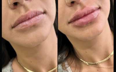 before and after results from filler treatment at 5th and Wellness in Boca Raton, FL