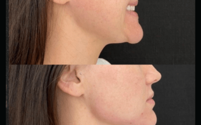 before and after results from filler treatment at 5th and Wellness in Boca Raton, FL