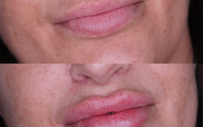 before and after results from filler treatment at 5th and Wellness in Boca Raton, FL