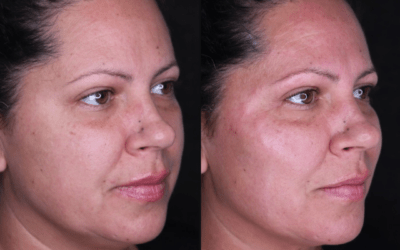 before and after results from filler treatment at 5th and Wellness in Boca Raton, FL