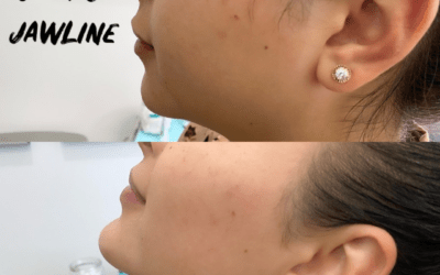 before and after results from filler treatment at 5th and Wellness in Boca Raton, FL