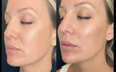 before and after results from filler treatment at 5th and Wellness in Boca Raton, FL