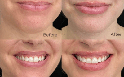 before and after results from filler treatment at 5th and Wellness in Boca Raton, FL