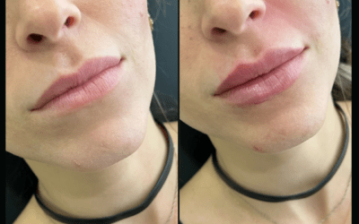 before and after results from filler treatment at 5th and Wellness in Boca Raton, FL