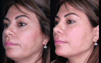 before and after results from filler treatment at 5th and Wellness in Boca Raton, FL