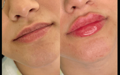 before and after results from filler treatment at 5th and Wellness in Boca Raton, FL