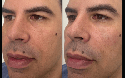 before and after results from filler treatment at 5th and Wellness in Boca Raton, FL